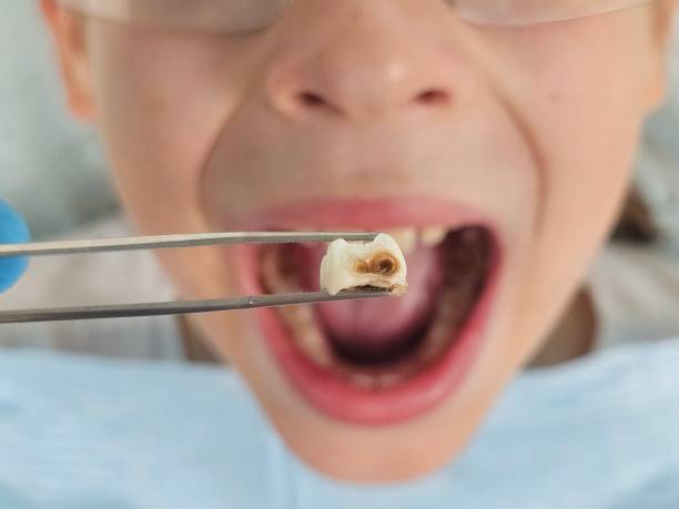 Best Emergency Dentist for Lost Fillings or Crowns in Lawai, HI